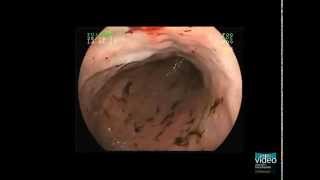 Hemorrhagic Gastropathy [upl. by Lucky]