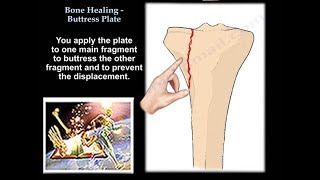 Bone Healing Buttress Plate  Everything You Need To Know  Dr Nabil Ebraheim [upl. by Bradford]