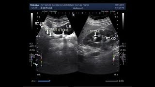 Ultrasound Video showing a renal stone with multiple ureteric stones [upl. by Felipe]