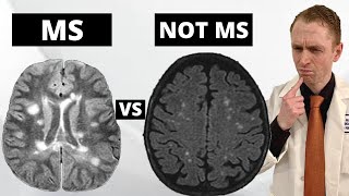 MS MRI Lesions VS quotBenignquot White Matter Lesions Explained by Neurologist [upl. by Nelag]