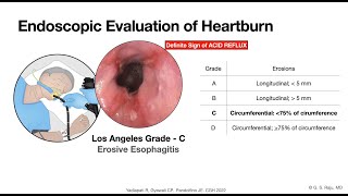 GERD  Endoscopic Evaluation  Esophageal Mucosa [upl. by Guria]