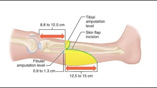 Transtibial Below Knee Amputation for the Ischemic Limbs [upl. by Ecyak]