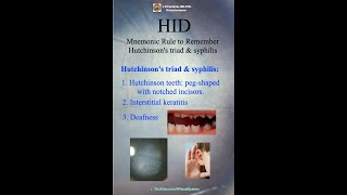 Hutchinsons Triad amp Syphilis HID Mnemonic Rule to Remember Hutchinsons Triad amp Syphilis [upl. by Arrek]