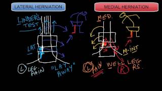 Lateral vs Medial Disc Herniations [upl. by Jarita]