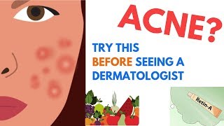 ACNE Treatments  Explained by Dermatologist [upl. by Ennoirb]