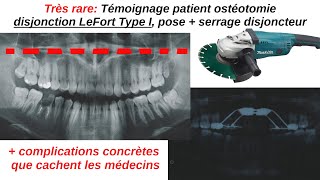 Témoignage patient ostéotomie disjonction LeFort type I chirurgien maxillofacial Dr Waddah Sabouni [upl. by Tami]