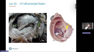 Online EP Les 15 RA isthmus afhankelijke flutter [upl. by Adlei]