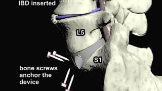 Anterior Lumbar Interbody Fusion ALIF Part 3 Animation by Cal Shipley MD [upl. by Benita]