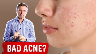 If Nothing is Working for Acne Try This Acne Removal Treatment – DrBerg [upl. by Georglana]