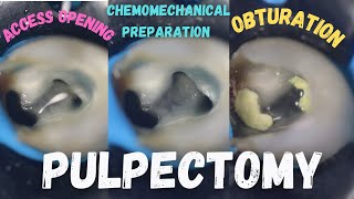 Pulpectomy  access opening  chemomechanical preparation  obturation  pulpectomy procedure 84 [upl. by Ahsercal728]