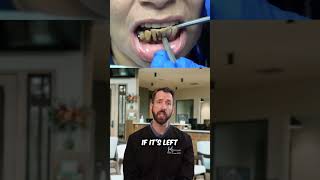 Dental Calculus  RR Dentistry  Georgetown TX [upl. by Inol]