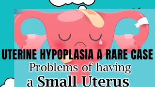 Uterine Hyoplasia A rare case🔙🔙🔙 [upl. by Champagne]