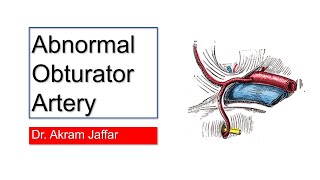 Abnormal aberrant obturator artery corona mortis [upl. by Ora]