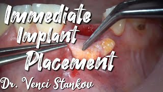 Immediate implant placement after extraction Dr Venci Stankov [upl. by Bronk]