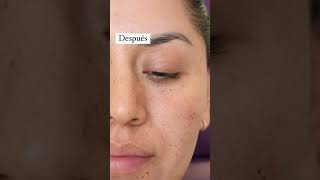 Aplicación de Ácido Hialuronico en Ojeras 😨✔ skincare derma botox ácidohialurônico filler [upl. by Ahmad895]