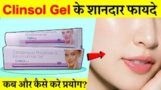 Clinsol Gel Review फायदे नुकसान और प्रयोग विधि  Clinsol Gel uses for Acne Pimples amp Glowing skin [upl. by Wain]