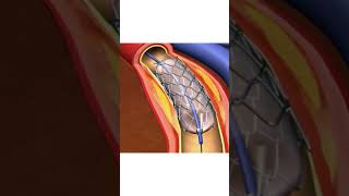 How heart stents work 1 SplitIt welding science [upl. by Kayla]