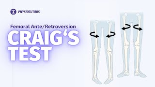 Craigs Test  Femoral Anteversion [upl. by Gunther]