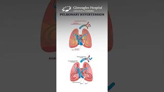 All About Pulmonary Arterial Hypertension Symptoms and Detection  Gleneagles Hospital [upl. by Macomber]