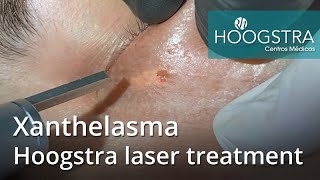 Xanthelasma  Hoogstra laser treatment 22082 [upl. by Chastain]