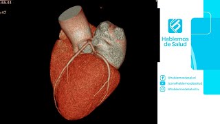 ANGIOTOMOGRAFÍA CORONARIA  DR FEDERICO LANDETA [upl. by Neuberger]