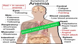 Anemia can be fatal  Sports Anemia  Delusional anemia  False Anemia  pseudoanemia  082020 [upl. by Allac]