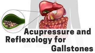 Acupressure and Reflexology for Gallstones  Massage Monday 385 [upl. by Leidgam]