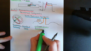 Cardiac Arrhythmias Part 7 [upl. by Allisirp579]