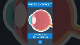 Weitsichtigkeit Diagnose und Behandlung  Kenhub shorts [upl. by Javed]