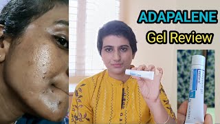 adapalene gel review telugu  adaferin gel for acne commedones and acne marks How to use adapalene [upl. by Ahsetra]