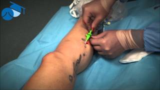 Multiple cannulation of complex recurrent varicose veins [upl. by Eimot702]