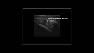 Subcoracoid anteromedial impingement of the subscapularis tendon on dynamic shoulder ultrasound [upl. by Yrrum]