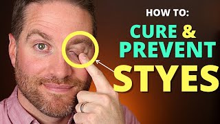 How To CURE And PREVENT STYES Get Rid Of A Hordeolum stye And Chalazion Fast [upl. by Best496]