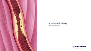 Arterienverkalkung Arteriosklerose und Angiografie [upl. by Maura116]