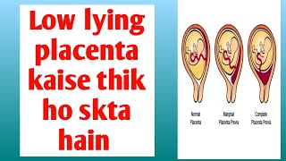 low lying placenta कैसे ठीक हो सकता है low lying placenta risk and precautions [upl. by Ahcire418]