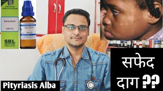 Pityriasis alba homeopathic treatment  explain चेहरे पर सफेद दाग [upl. by Kobylak]