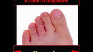 Ringworm Pics  How To Know If You Are Infected [upl. by Fifi]