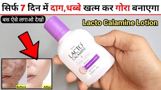 Lacto Calamine Face Lotion Review  lacto calamine face lotion kaise use kare  lacto calamine [upl. by Emie]