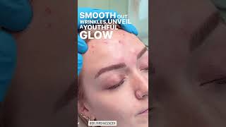 Forehead Botox for a Youthful Glow  EDEN AESTHETICS Dubai [upl. by Iddet762]