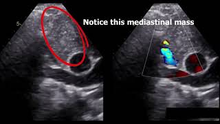 SVC syndrome diagnosis by echocardiography [upl. by Ixela247]