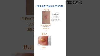 SKIN LESIONS Vesicle Vs Bulla [upl. by Gene29]