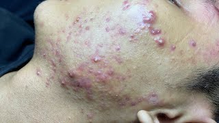 ACNE TREATMENT VU QUYNH MI Blackheads On Boy Face 2024 [upl. by Ylrrad171]