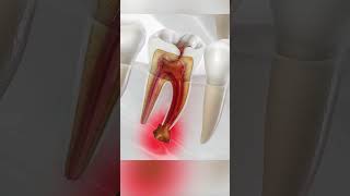 An Overview of Abscessed Teeth Causes Symptoms and Treatment [upl. by Editha]