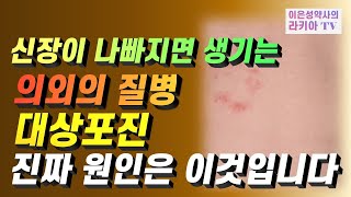 신장이 나빠지면 생기는 의외의 질병 대상포진 진짜 원인은 이것입니다대상포진 초기증상이은성약사의라키아TV [upl. by Offen]