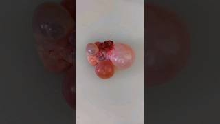 Polycystic ovary grossing video  histopathology uterinefibroid cystitis placentahistology tb [upl. by Tansy283]