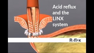 Reflux Disease and LINX Treatment [upl. by Tingey]