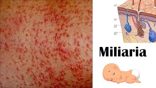 Miliaria Heat rash [upl. by Cohbath]