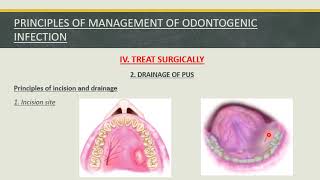 Fall 2020  Oral surgery 3  Lec 1  Orofacial infection [upl. by Iniffit]