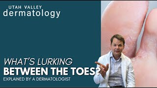 Whats Lurking Between the Toes  Utah Valley Dermatology [upl. by Portie]