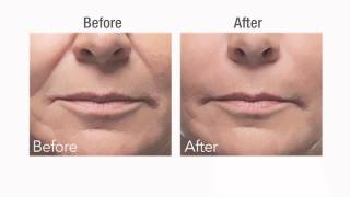 Botox vs Dermal Fillers [upl. by Nnyled569]